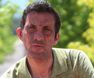 Türkiye’nin İlk Yüz Nakli: Uğur Acar’ın Hayata Tutunma Mücadelesi